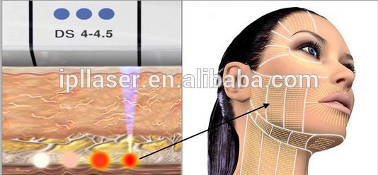 SMAS-Samentrekking Liposonix 13mm HIFU-Machine die het Verzakken van Huid vermindert